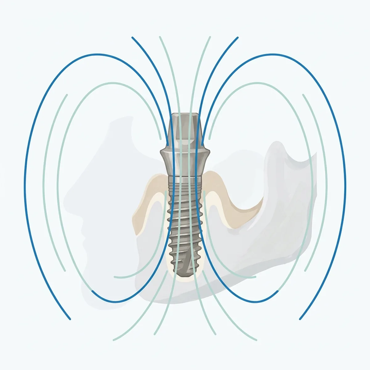 임플란트 해도 MRI 찍을 수 있을까? 주의사항과 안전성 전체 정리